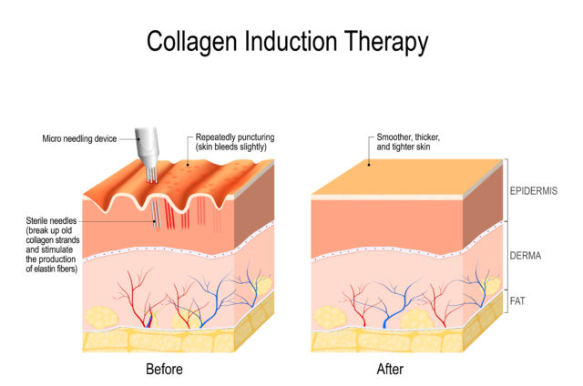 microneedling-collagen