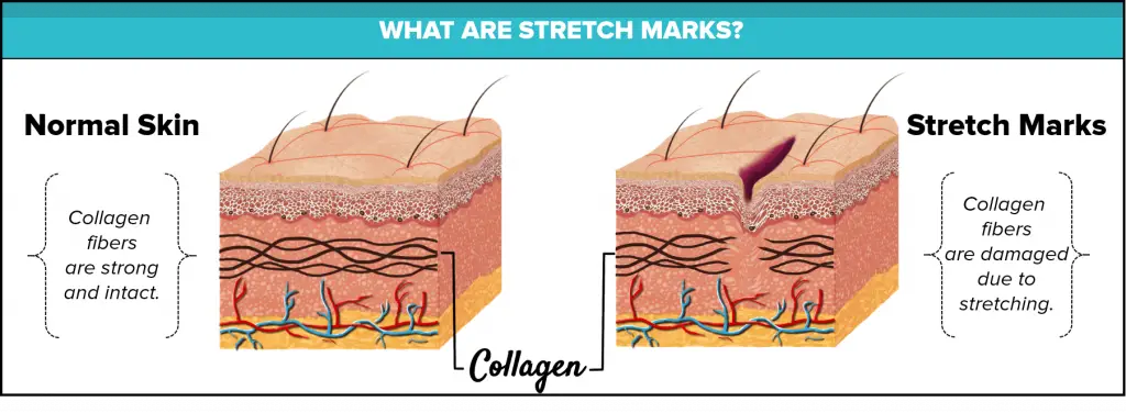 what-are-stretch-marks-infographic